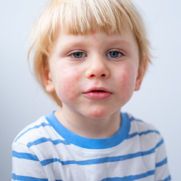 Atopic dermatitis in children