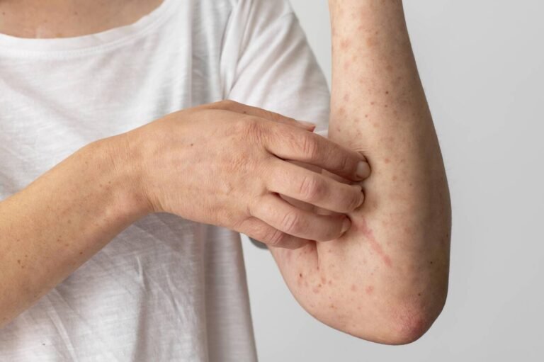 papular urticaria